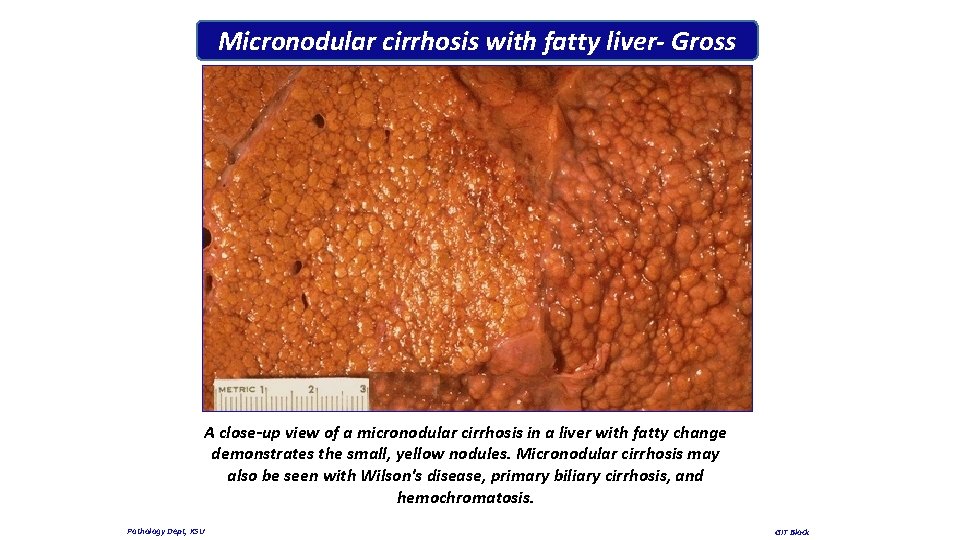 Micronodular cirrhosis with fatty liver- Gross A close-up view of a micronodular cirrhosis in