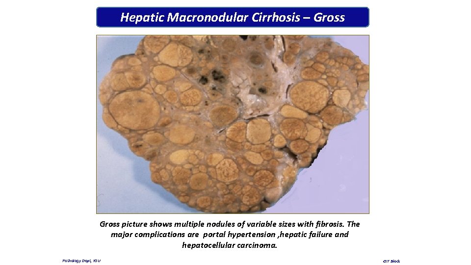 Hepatic Macronodular Cirrhosis – Gross picture shows multiple nodules of variable sizes with fibrosis.