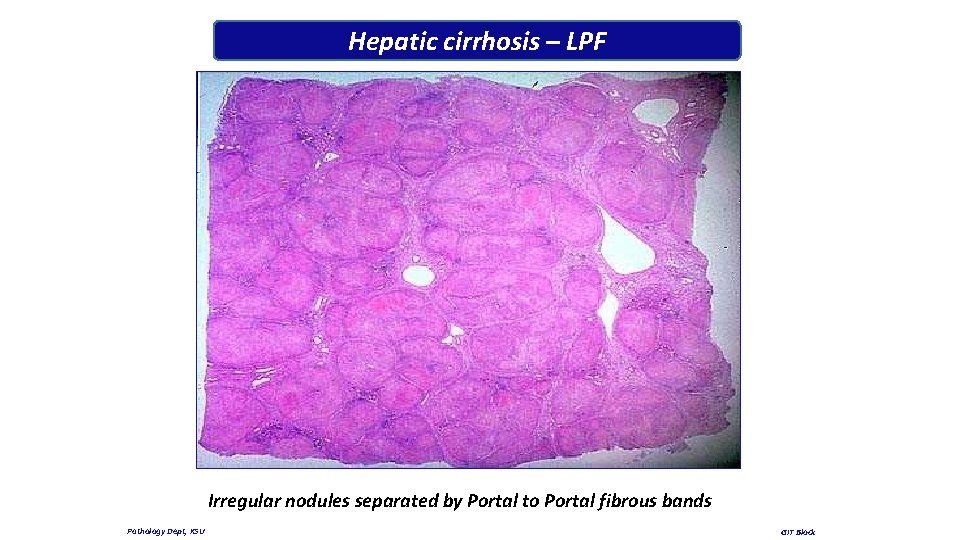 Hepatic cirrhosis – LPF Irregular nodules separated by Portal to Portal fibrous bands Pathology