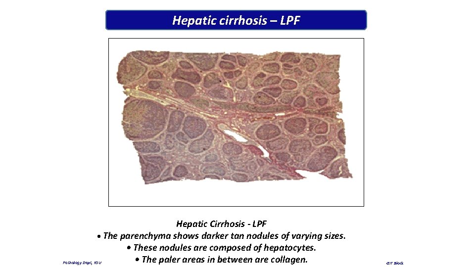 Hepatic cirrhosis – LPF Hepatic Cirrhosis - LPF • The parenchyma shows darker tan