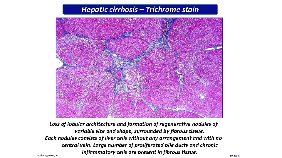 Hepatic cirrhosis – Trichrome stain Loss of lobular architecture and formation of regenerative nodules