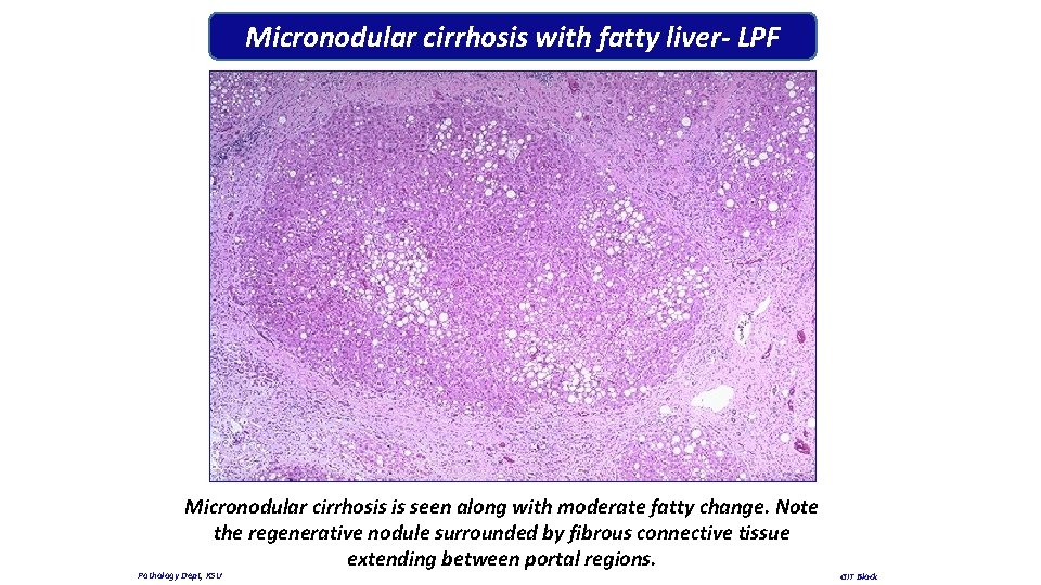 Micronodular cirrhosis with fatty liver- LPF Micronodular cirrhosis is seen along with moderate fatty