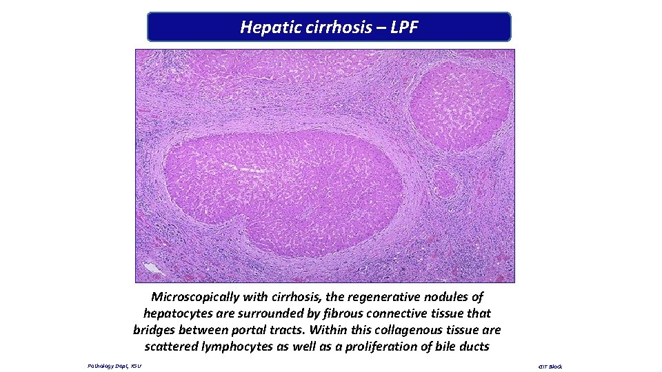 Hepatic cirrhosis – LPF Microscopically with cirrhosis, the regenerative nodules of hepatocytes are surrounded