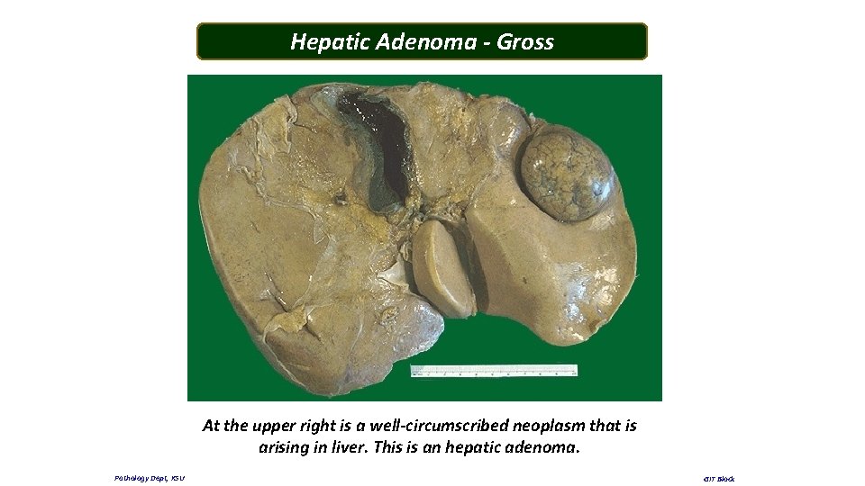 Hepatic Adenoma - Gross At the upper right is a well-circumscribed neoplasm that is