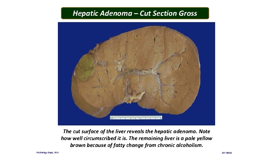 Hepatic Adenoma – Cut Section Gross The cut surface of the liver reveals the