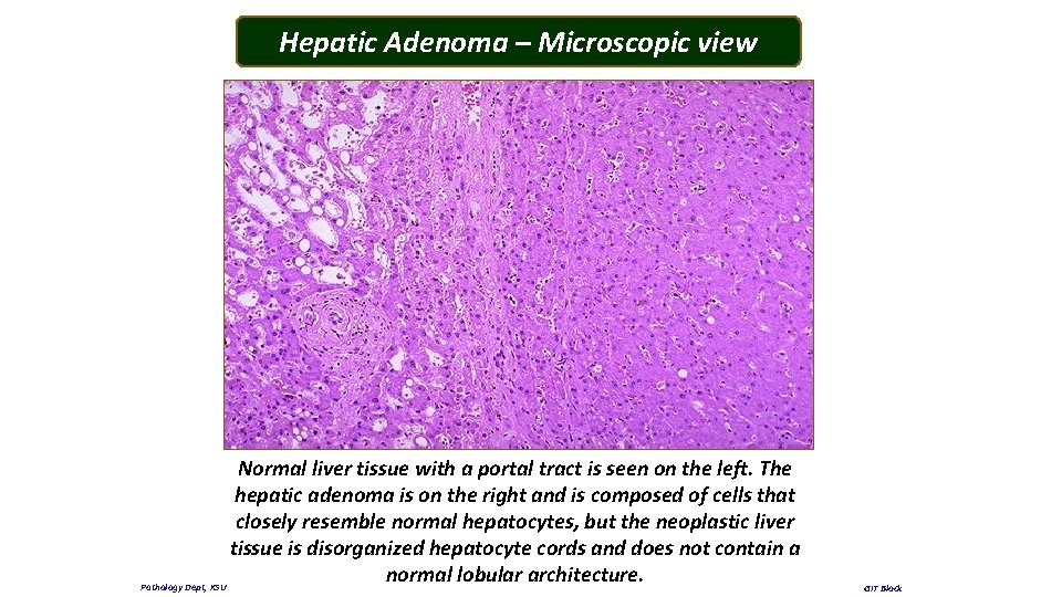 Hepatic Adenoma – Microscopic view Normal liver tissue with a portal tract is seen