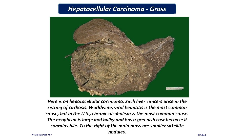 Hepatocellular Carcinoma - Gross Here is an hepatocellular carcinoma. Such liver cancers arise in