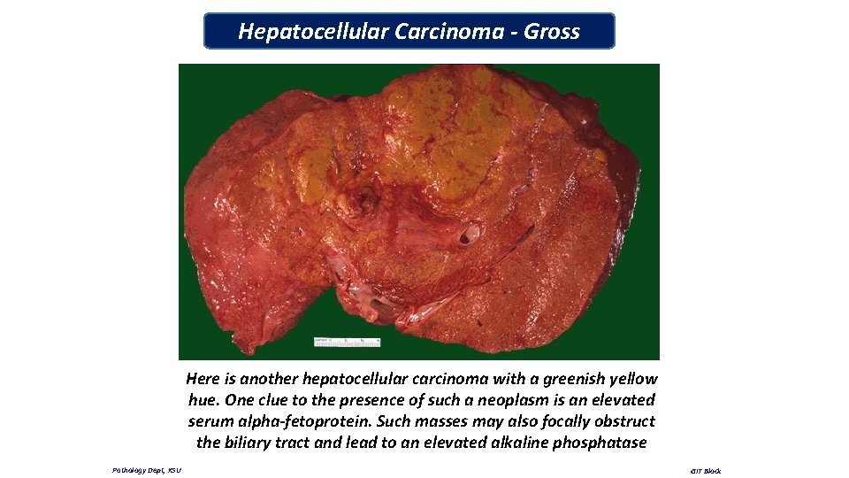 Hepatocellular Carcinoma - Gross Here is another hepatocellular carcinoma with a greenish yellow hue.