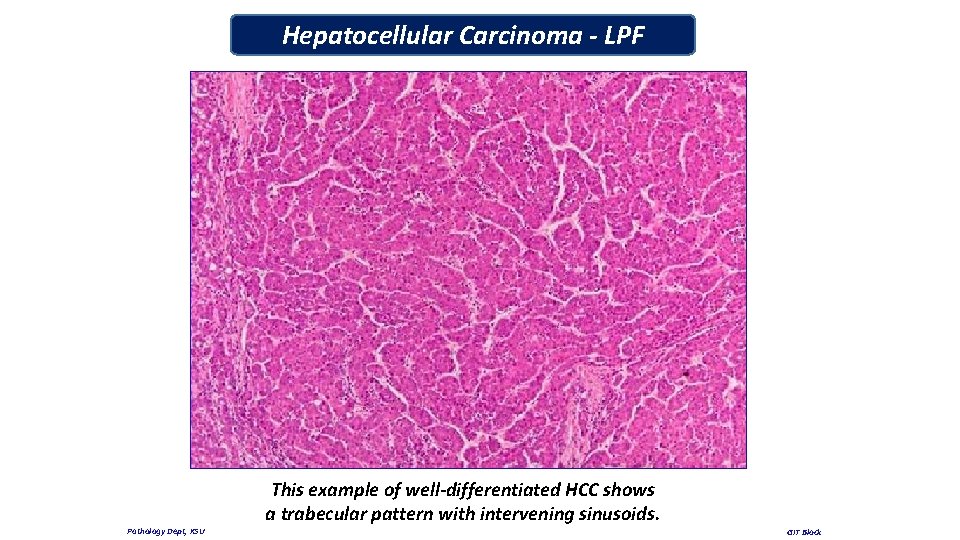 Hepatocellular Carcinoma - LPF Pathology Dept, KSU This example of well-differentiated HCC shows a