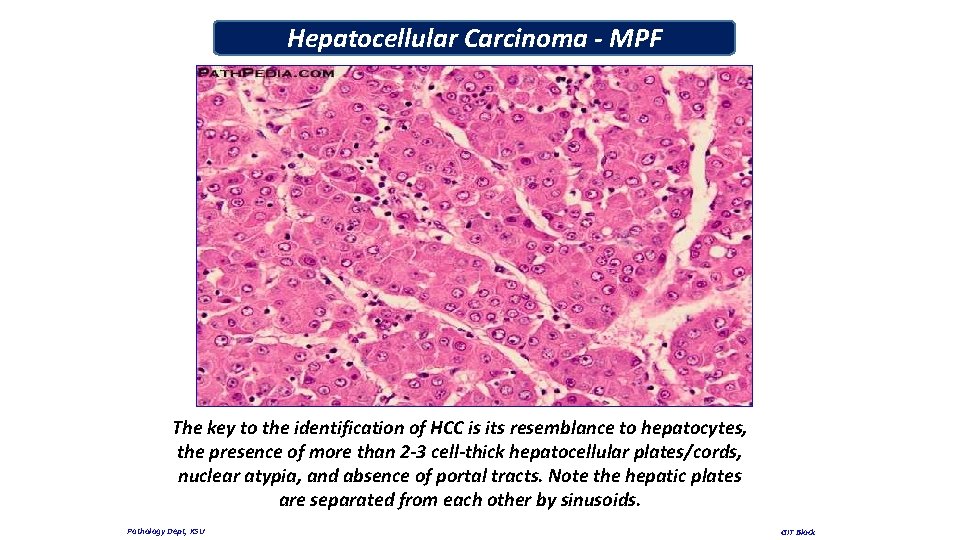 Hepatocellular Carcinoma - MPF The key to the identification of HCC is its resemblance