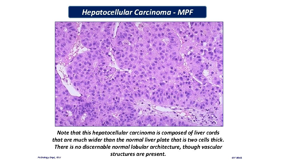 Hepatocellular Carcinoma - MPF Note that this hepatocellular carcinoma is composed of liver cords