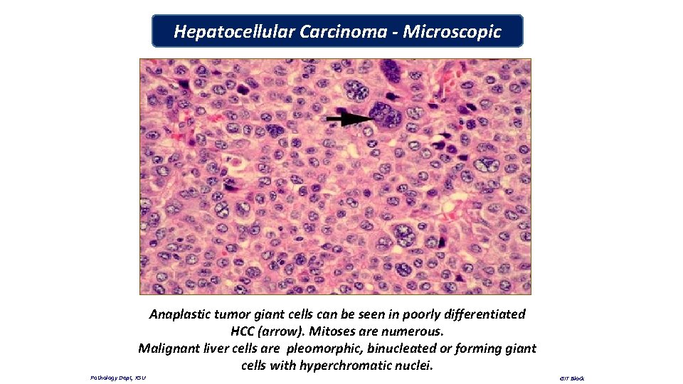 Hepatocellular Carcinoma - Microscopic Anaplastic tumor giant cells can be seen in poorly differentiated