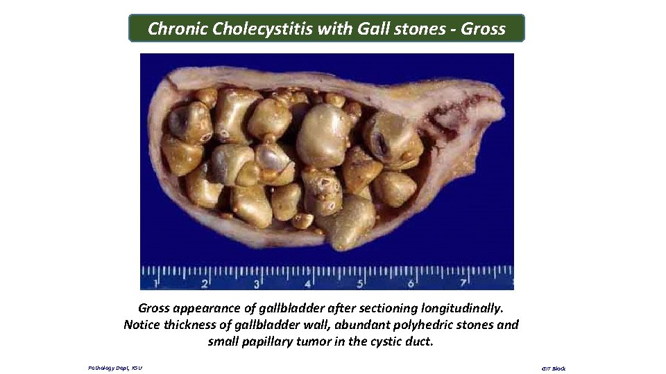 Chronic Cholecystitis with Gall stones - Gross appearance of gallbladder after sectioning longitudinally. Notice