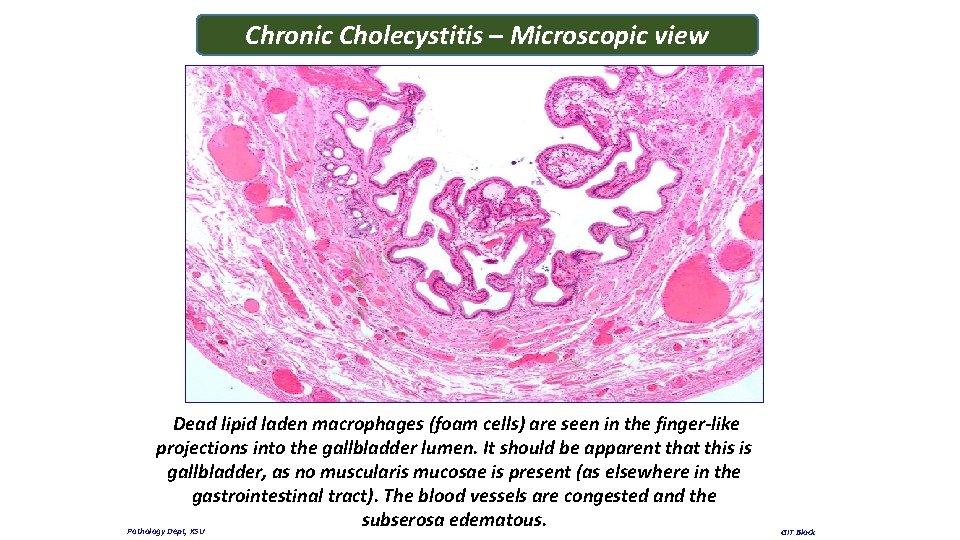 Chronic Cholecystitis – Microscopic view Dead lipid laden macrophages (foam cells) are seen in