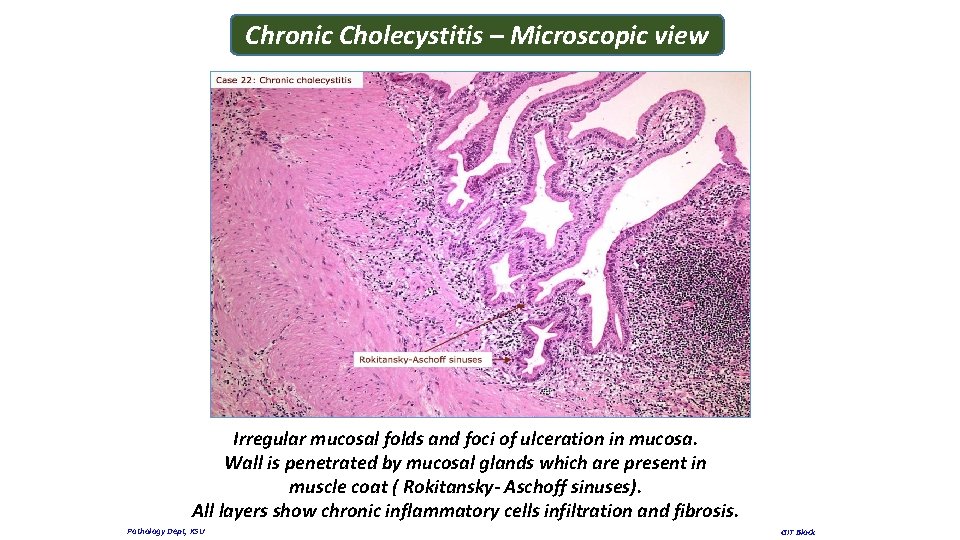 Chronic Cholecystitis – Microscopic view Irregular mucosal folds and foci of ulceration in mucosa.