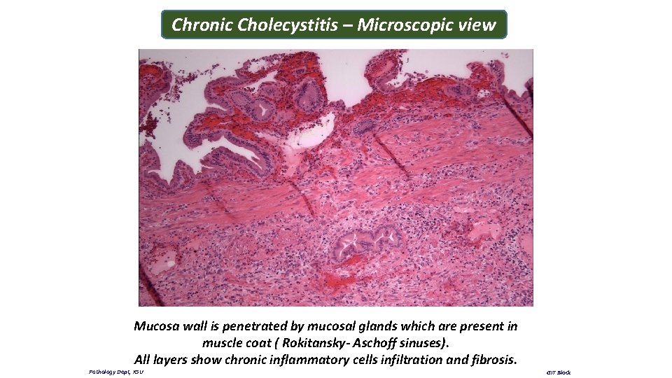 Chronic Cholecystitis – Microscopic view Mucosa wall is penetrated by mucosal glands which are