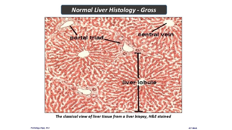 Normal Liver Histology - Gross The classical view of liver tissue from a liver