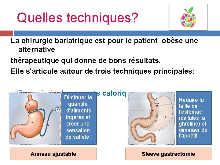 Quelles techniques? La chirurgie bariatrique est pour le patient obèse une alternative thérapeutique qui