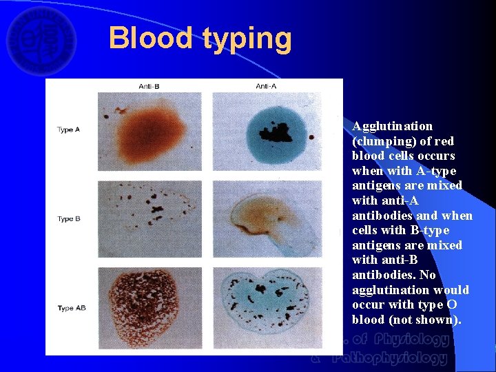Blood typing Agglutination (clumping) of red blood cells occurs when with A-type antigens are