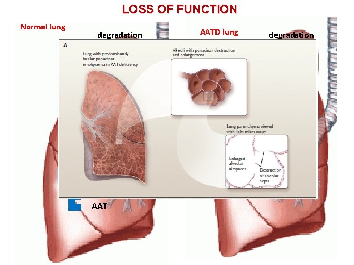 LOSS OF FUNCTION Normal lung degradation AATD lung degradation HNE AAT 