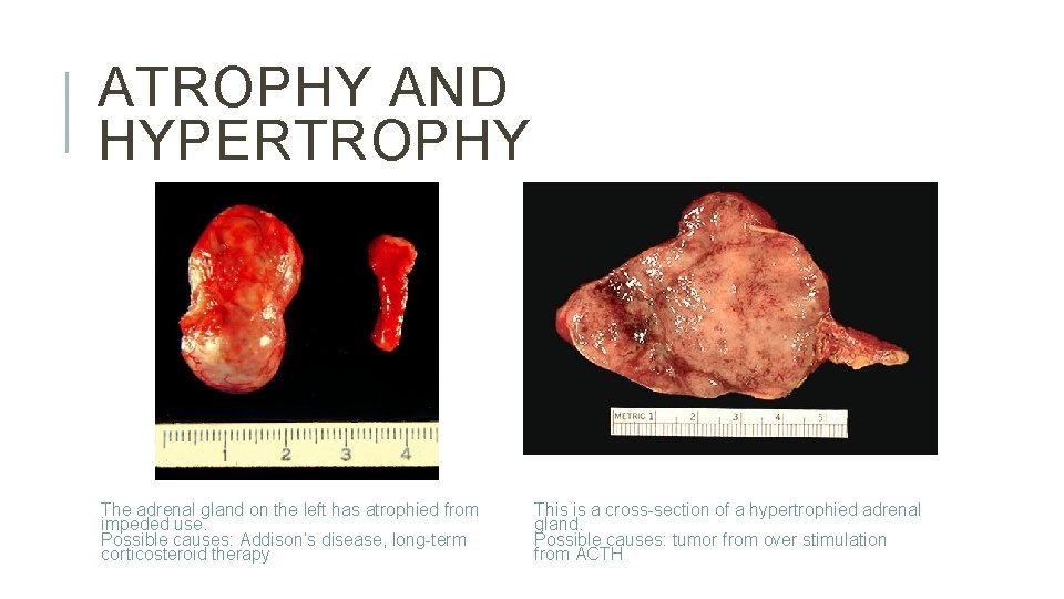 ATROPHY AND HYPERTROPHY The adrenal gland on the left has atrophied from impeded use.