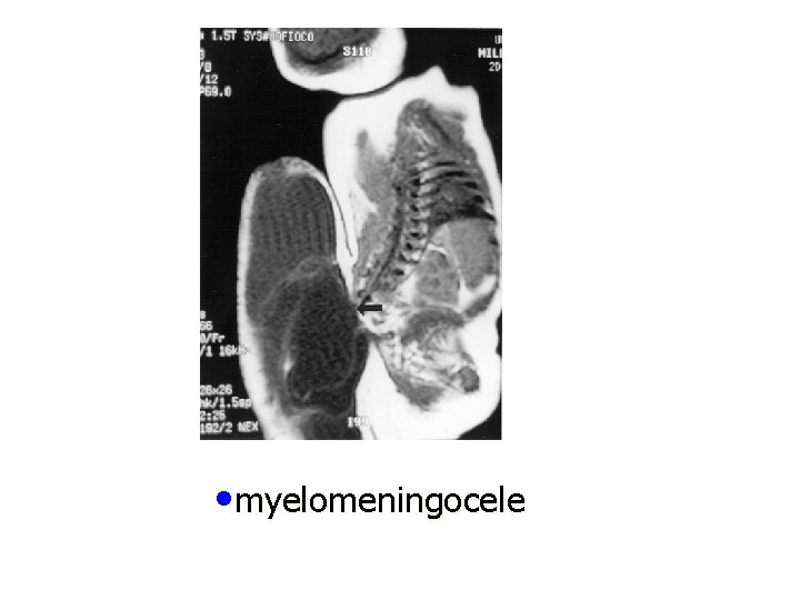  • myelomeningocele 