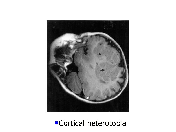  • Cortical heterotopia 