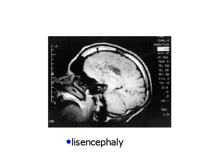  • lisencephaly 