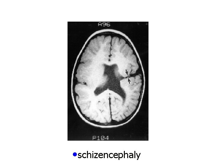  • schizencephaly 