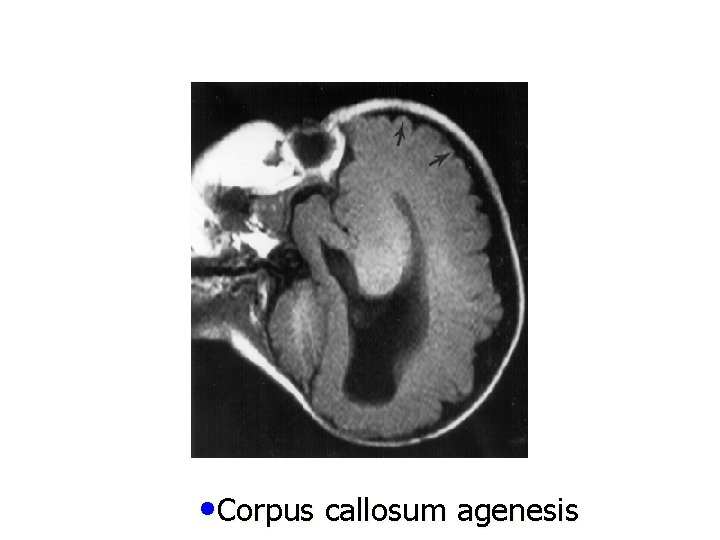  • Corpus callosum agenesis 