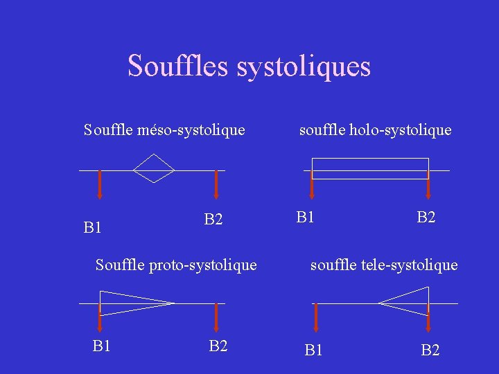 Souffles systoliques Souffle méso-systolique B 1 B 2 Souffle proto-systolique B 1 B 2