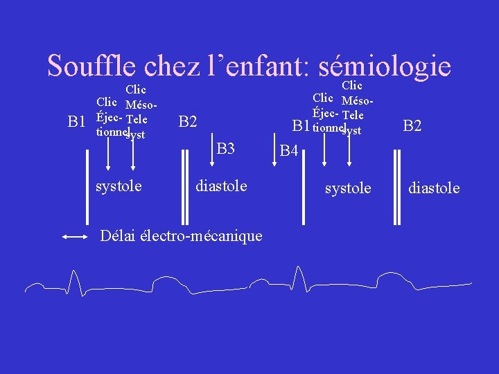 Souffle chez l’enfant: sémiologie Clic B 1 Clic MésoÉjec- Tele tionnelsystole Clic MésoÉjec- Tele