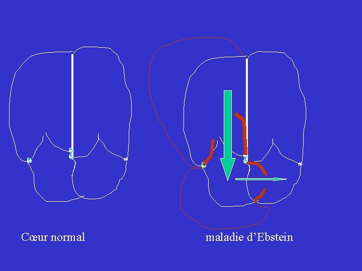 Cœur normal maladie d’Ebstein 