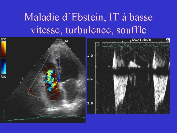 Maladie d’Ebstein, IT à basse vitesse, turbulence, souffle 