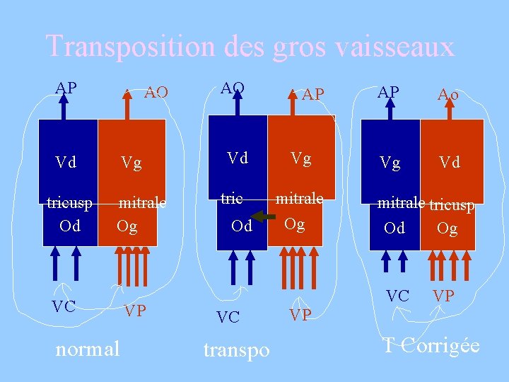 Transposition des gros vaisseaux AP AO Vd tricusp Od Vg mitrale Og VC normal