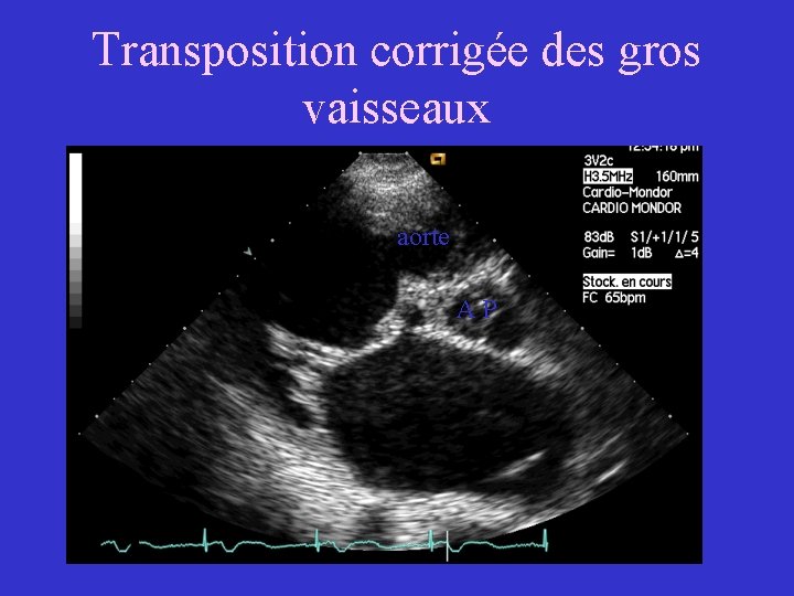 Transposition corrigée des gros vaisseaux aorte AP 