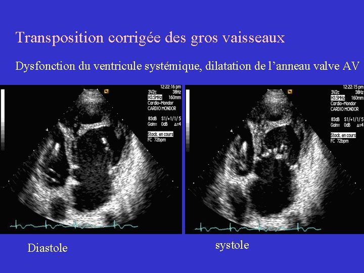 Transposition corrigée des gros vaisseaux Dysfonction du ventricule systémique, dilatation de l’anneau valve AV