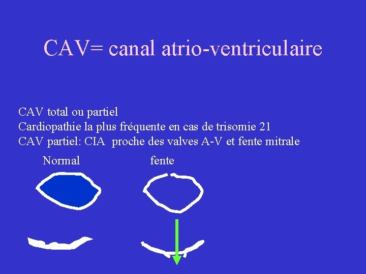 CAV= canal atrio-ventriculaire CAV total ou partiel Cardiopathie la plus fréquente en cas de