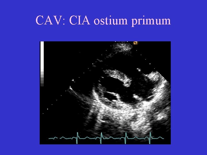 CAV: CIA ostium primum 