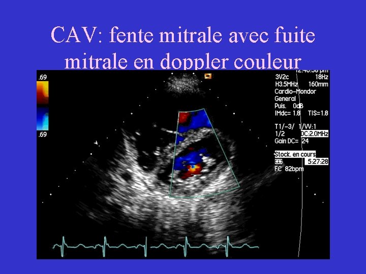 CAV: fente mitrale avec fuite mitrale en doppler couleur 