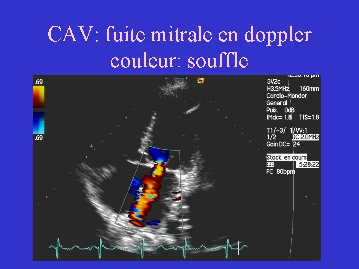 CAV: fuite mitrale en doppler couleur: souffle 