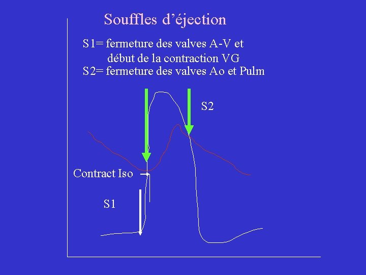 Souffles d’éjection S 1= fermeture des valves A-V et début de la contraction VG