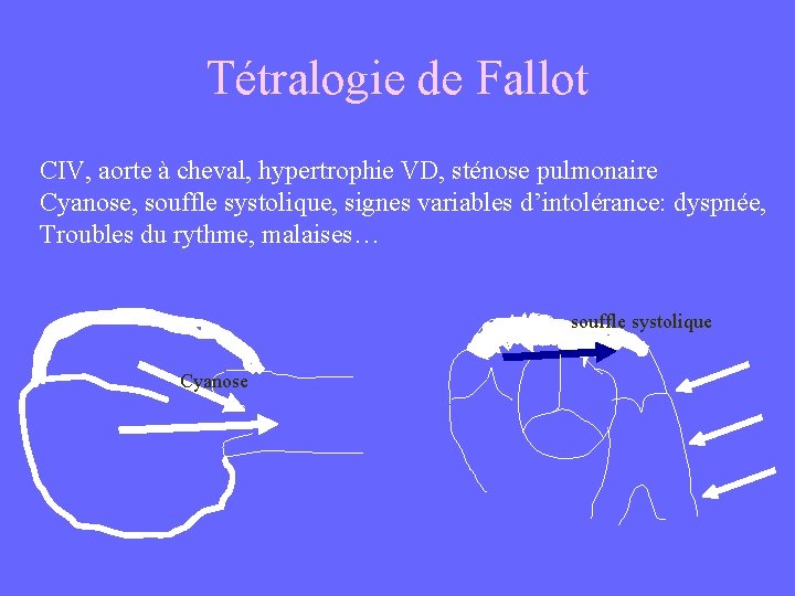 Tétralogie de Fallot CIV, aorte à cheval, hypertrophie VD, sténose pulmonaire Cyanose, souffle systolique,