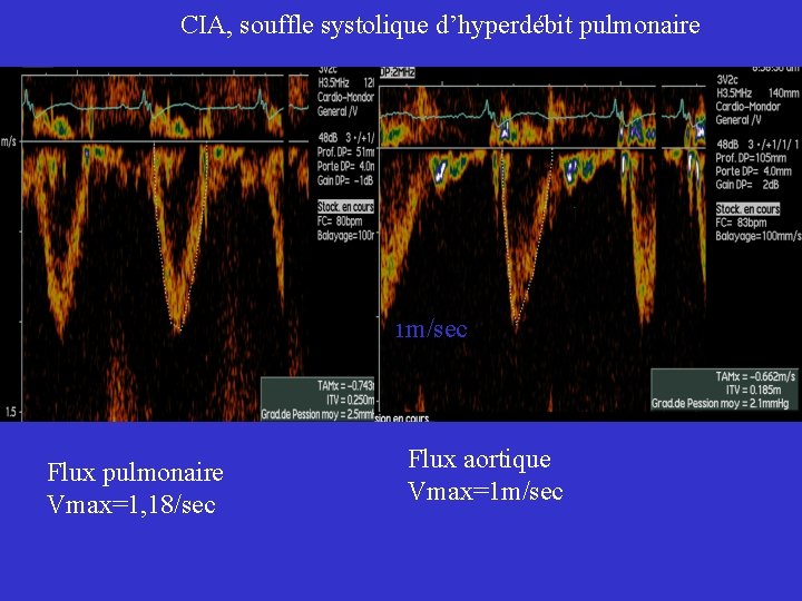 CIA, souffle systolique d’hyperdébit pulmonaire 1 m/sec Flux pulmonaire Vmax=1, 18/sec Flux aortique Vmax=1