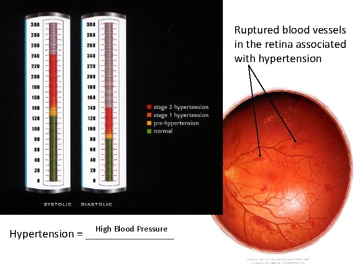 Ruptured blood vessels in the retina associated with hypertension High Blood Pressure Hypertension =
