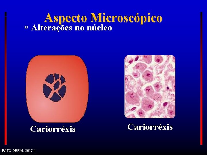 Aspecto Microscópico Alterações no núcleo Cariorréxis PATO GERAL 2017 -1 Cariorréxis 