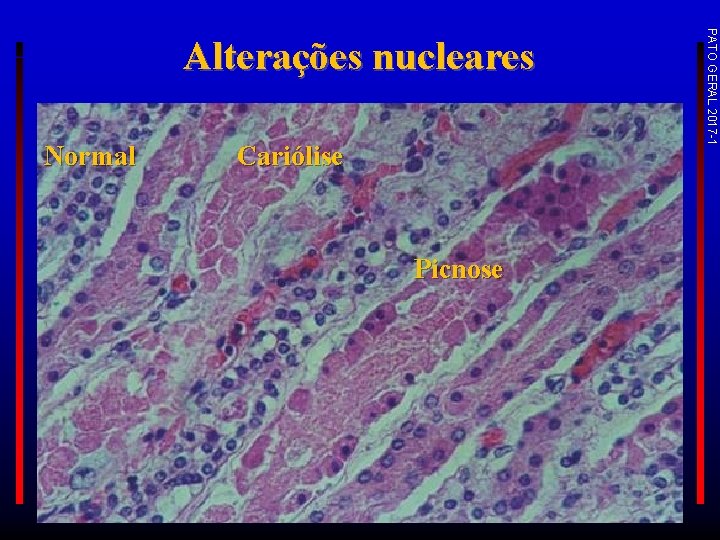 Normal Cariólise Picnose PATO GERAL 2017 -1 Alterações nucleares 