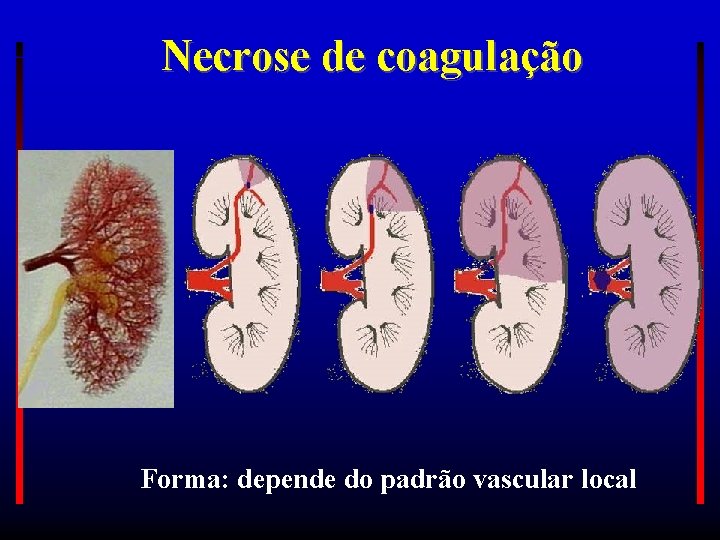 Necrose de coagulação Forma: depende do padrão vascular local 