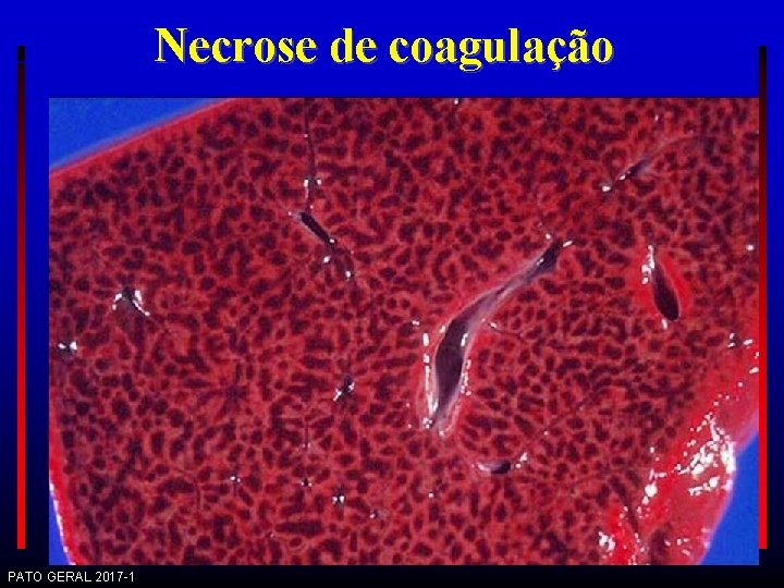 Necrose de coagulação PATO GERAL 2017 -1 
