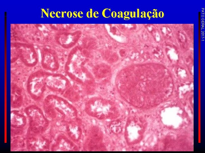 PATO GERAL 2017 -1 Necrose de Coagulação 
